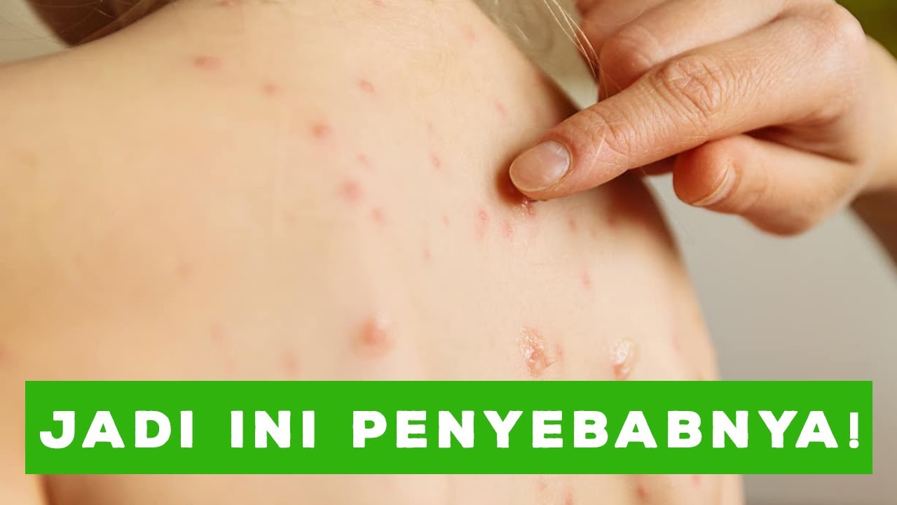 Hati-hati Terkena Herpes ! Kenali Penyakit Kulit Yang Disebabkan Oleh Virus !