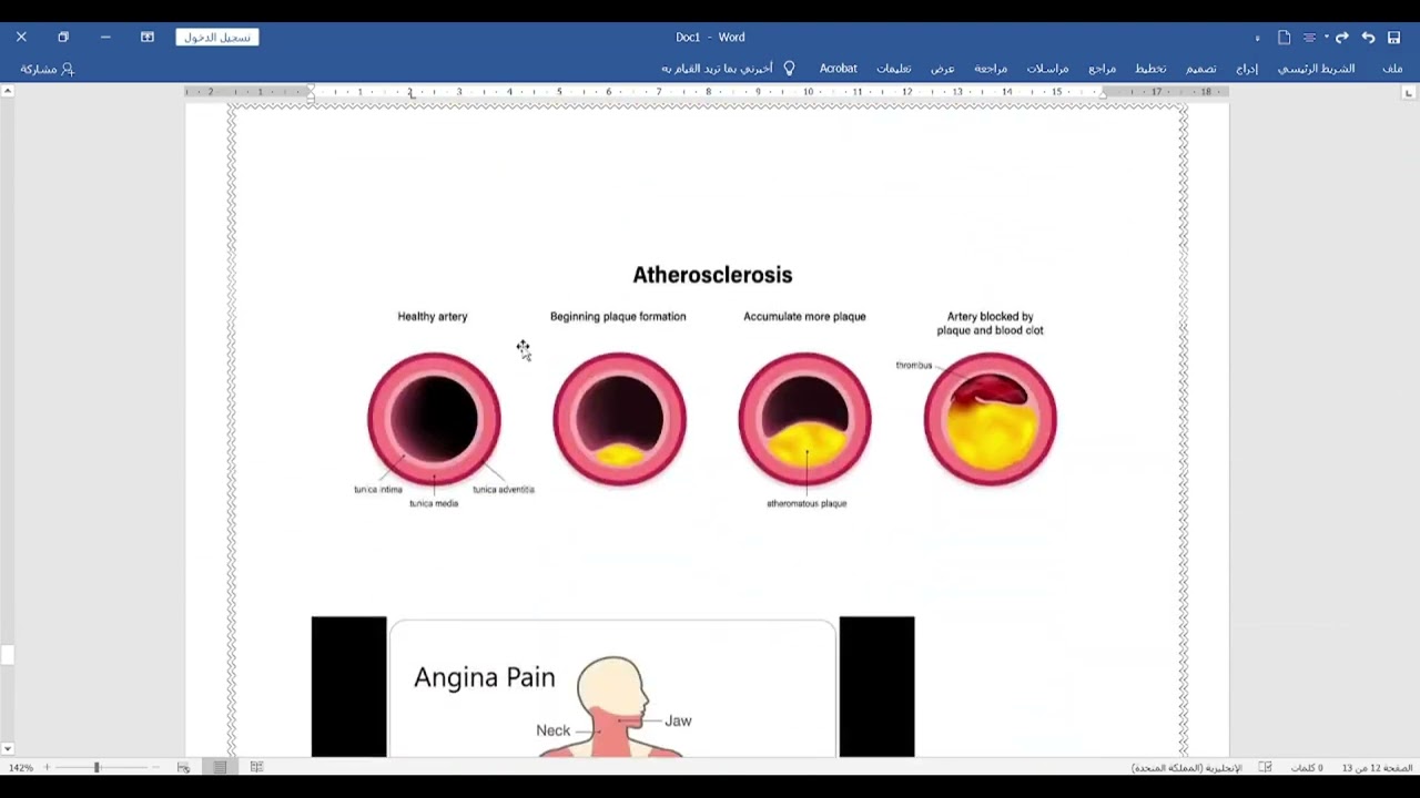 Ischemic Heart diseases+ angina pectoris