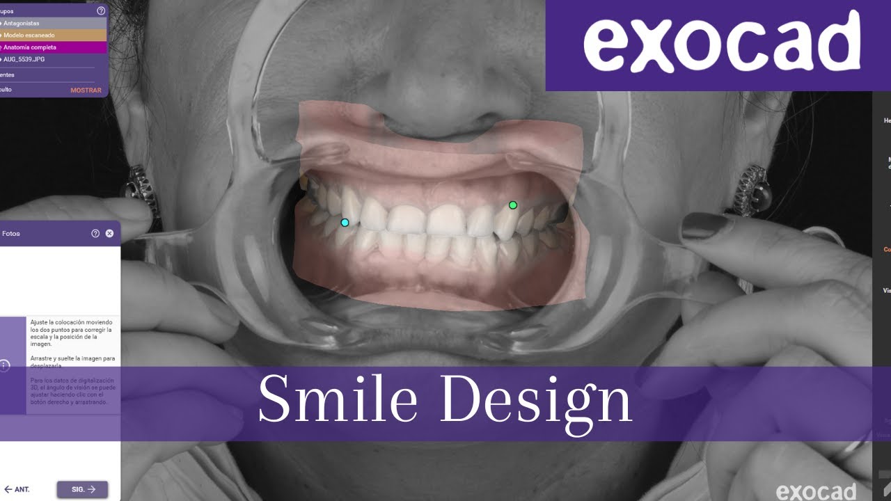 Diseño digital de sonrisa💥 [Conoce smile design de exocad]