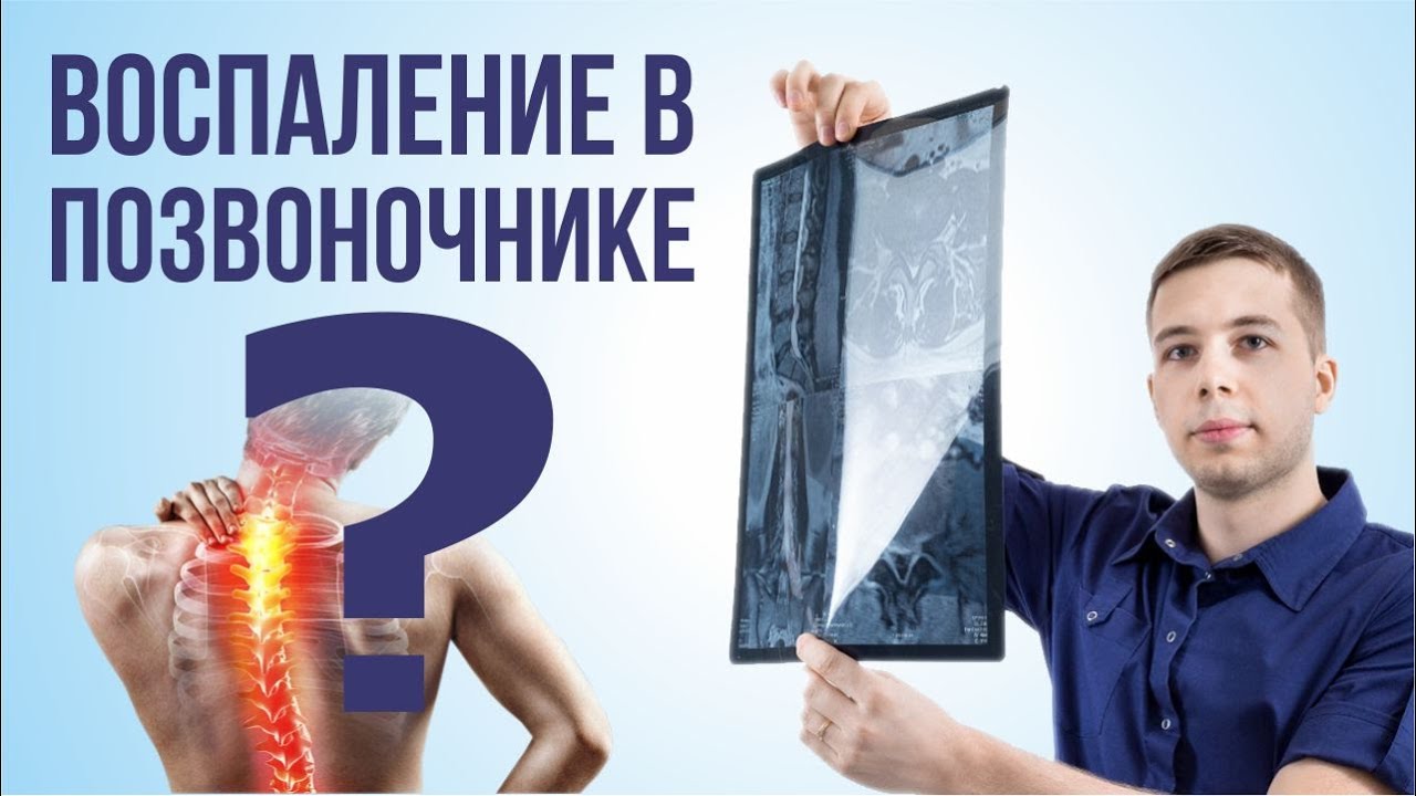 Воспаление в позвоночнике? Сакроилеит и болезнь Бехтерева в практике невролога. Что делать?