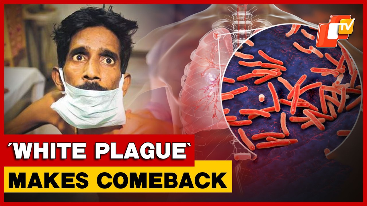&lsquo;White Plague&rsquo; Returns: TB Cases Rise Again Across The United States