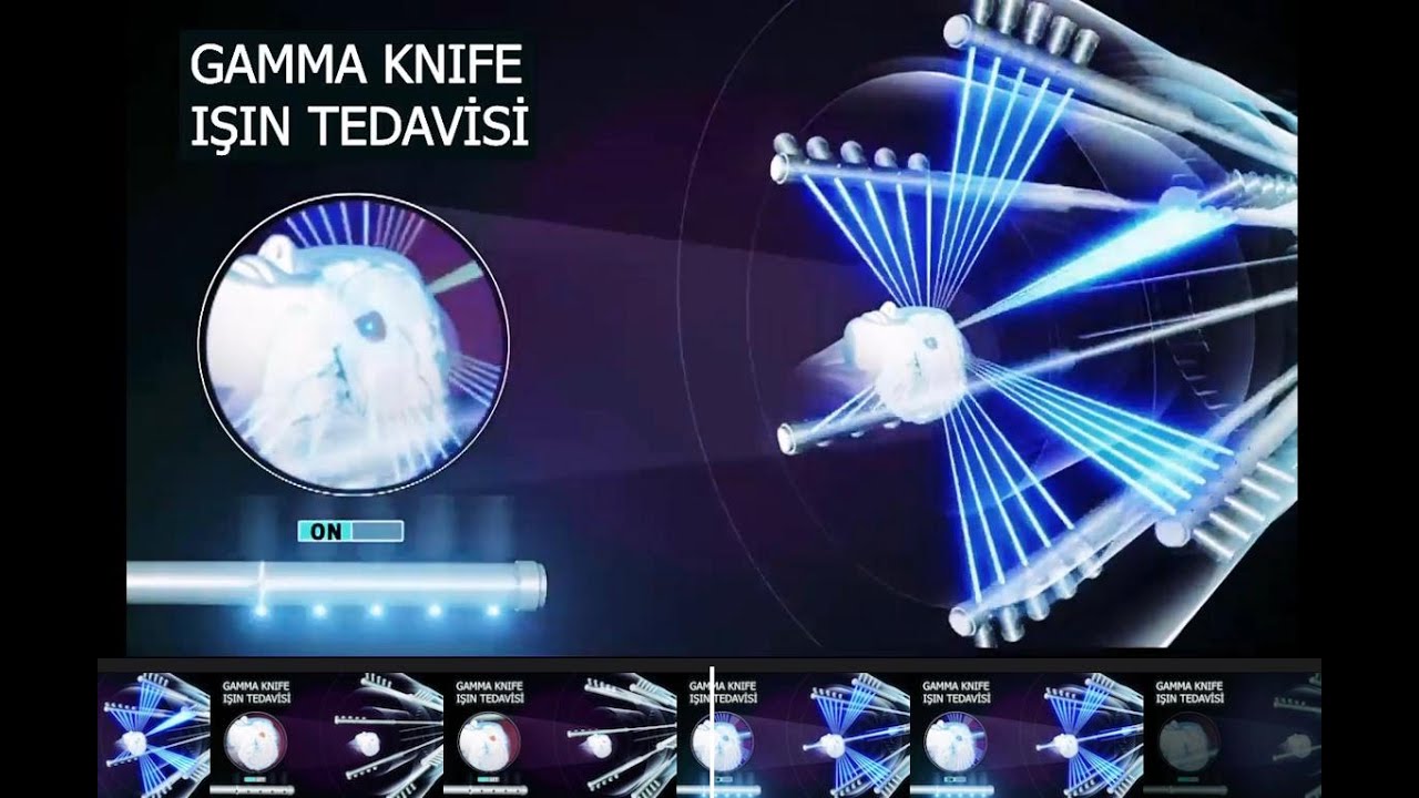 GAMMA KNİFE ''IŞIN TEDAVİSİ'' DOÇ.DR.AŞKIN ŞEKER