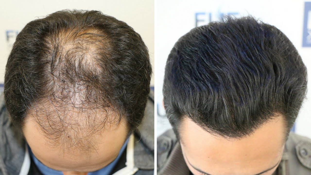 Injerto Capilar FUE (3584 Injertos - Alopecia NW V) Dr. Couto - FUEXPERT CLINIC - Recuperar Pelo