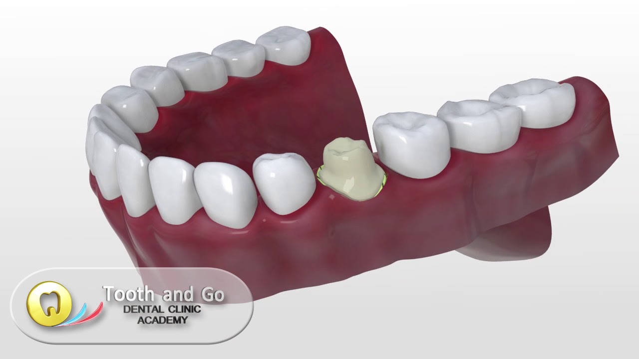 Cerec  -the ultimate chair side Cad Cam Technology - now also in the Philippines!