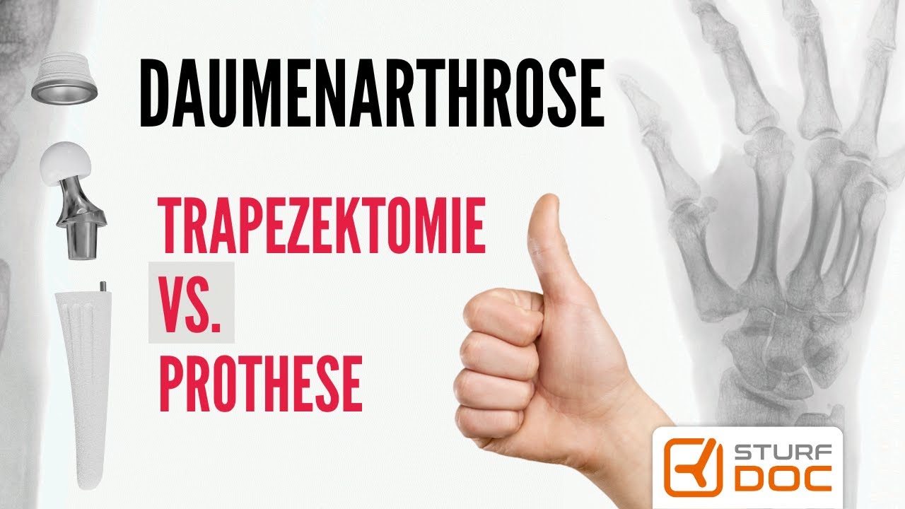 Prothese besser als Trapezektomie bei Daumensattelgelenksarthrose - Rhizarthrose