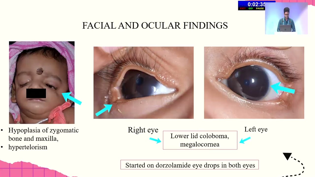 AIOS2025 HP Glaucoma+ FP689 Dr  Sathesh BASKARAN Rare Ocular Presentation of  Megalocornea and High