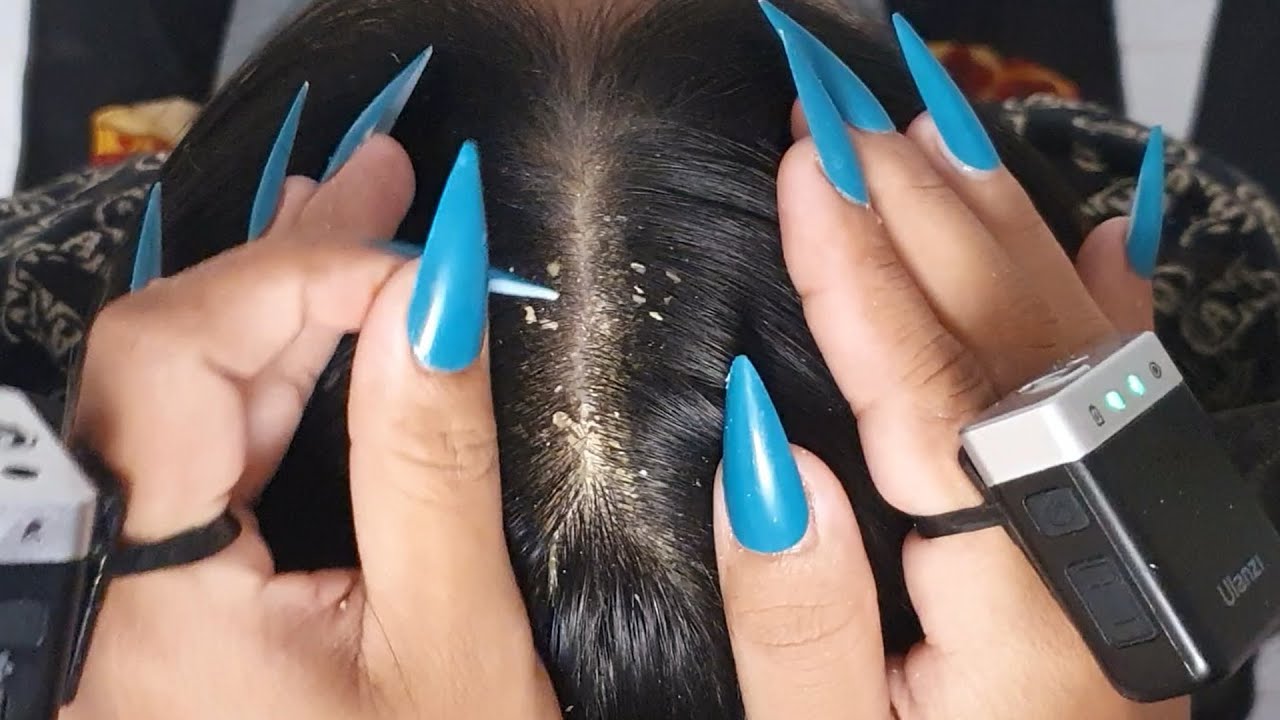 Itchy Scalp Deep Clean ASMR 🌙 | Heavy Dandruff, Gentle Scratching & Tingles #VF0174