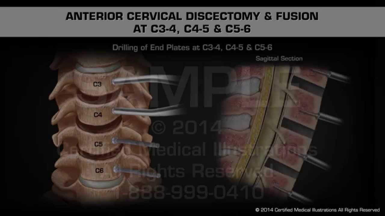 Anterior Cervical Discectomy & Fusion at C3-4, C4-5 & C5-6