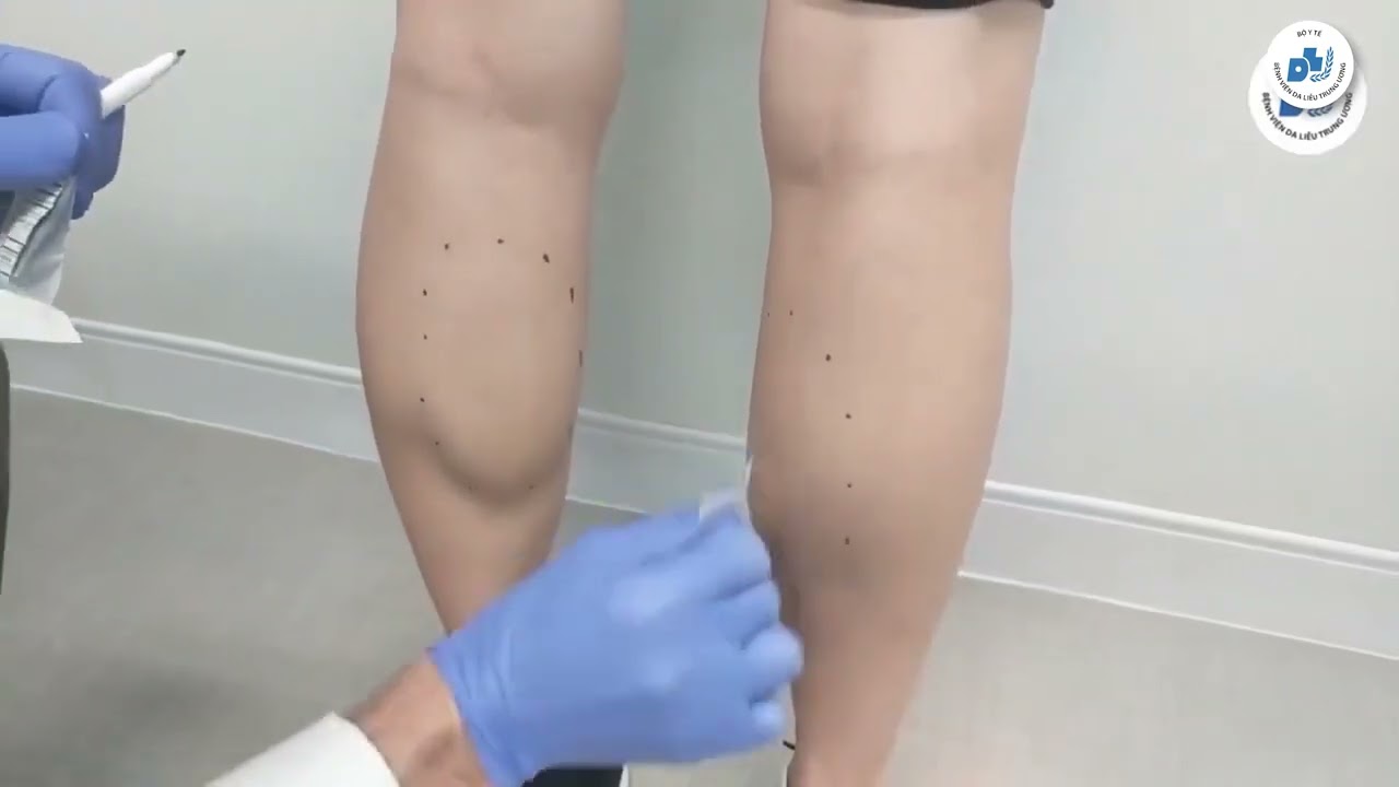 Trẻ hóa da bằng độc tố Botulinum Toxin
