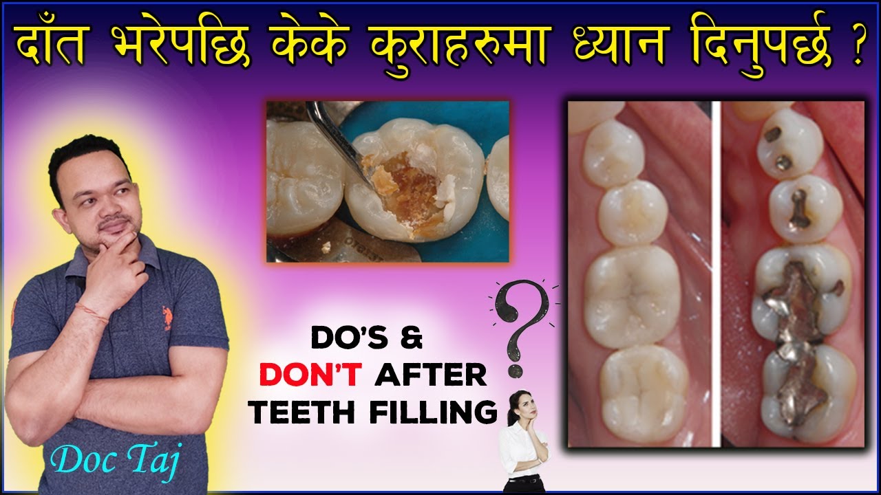 दाँत भरेपछि ध्यान दिनुपर्ने कुराहरु/Post teeth filling instructions/Do's& Don'ts after teeth filling