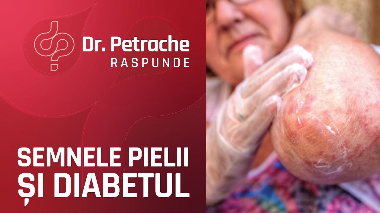 SEMNE DE DIABET CE APAR PE PIELE