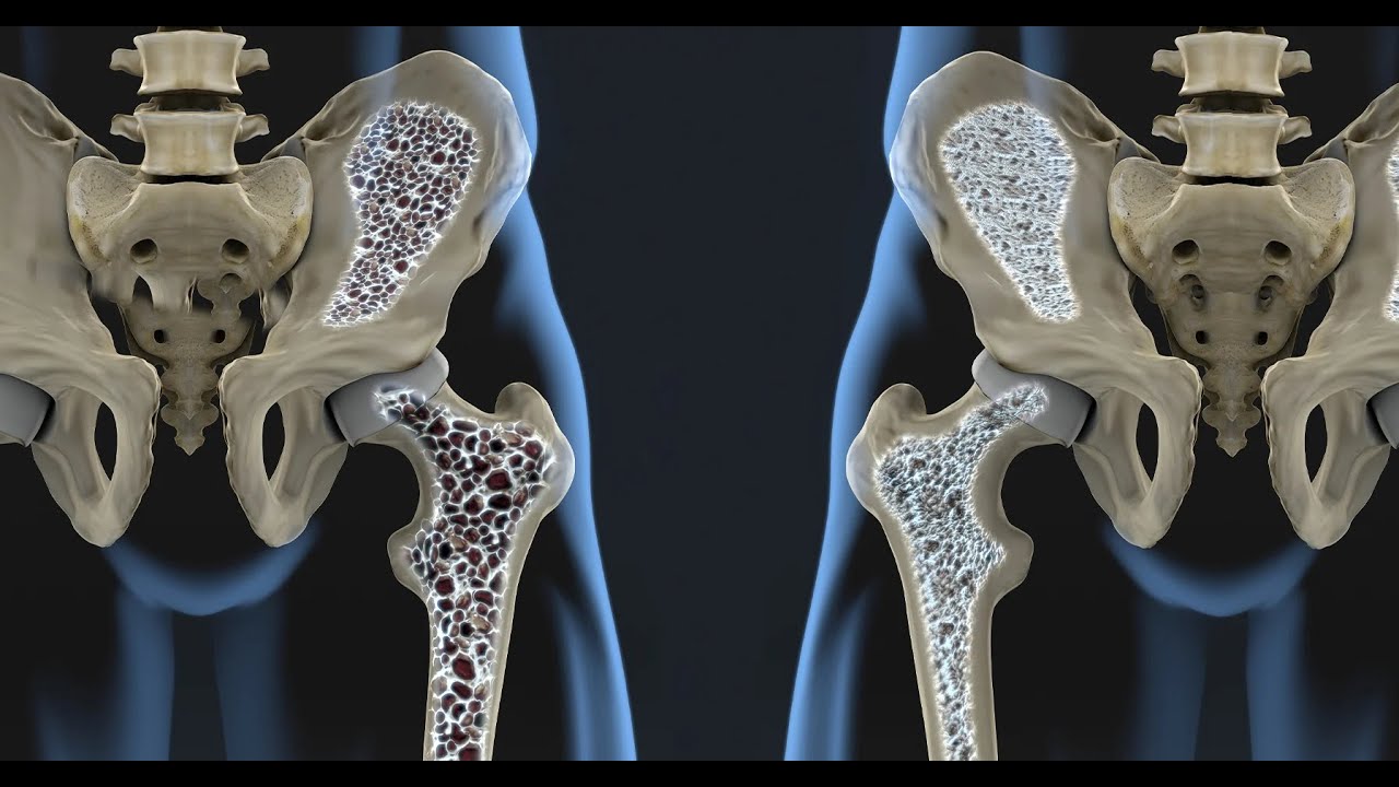 Tratamentul osteoporozei în 2025: ce funcționează cu adevărat