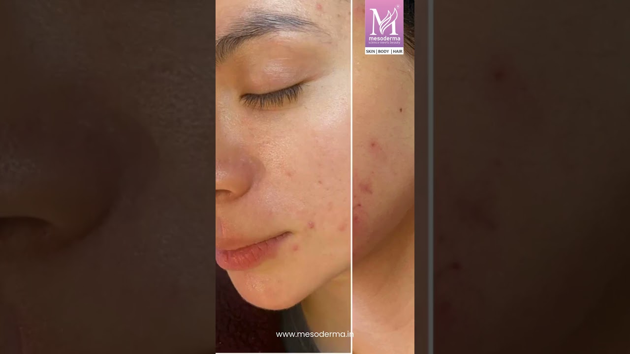 Say goodbye to pimples, blemishes & uneven skin. #skintreatment #dermatology #skindoctors #shorts