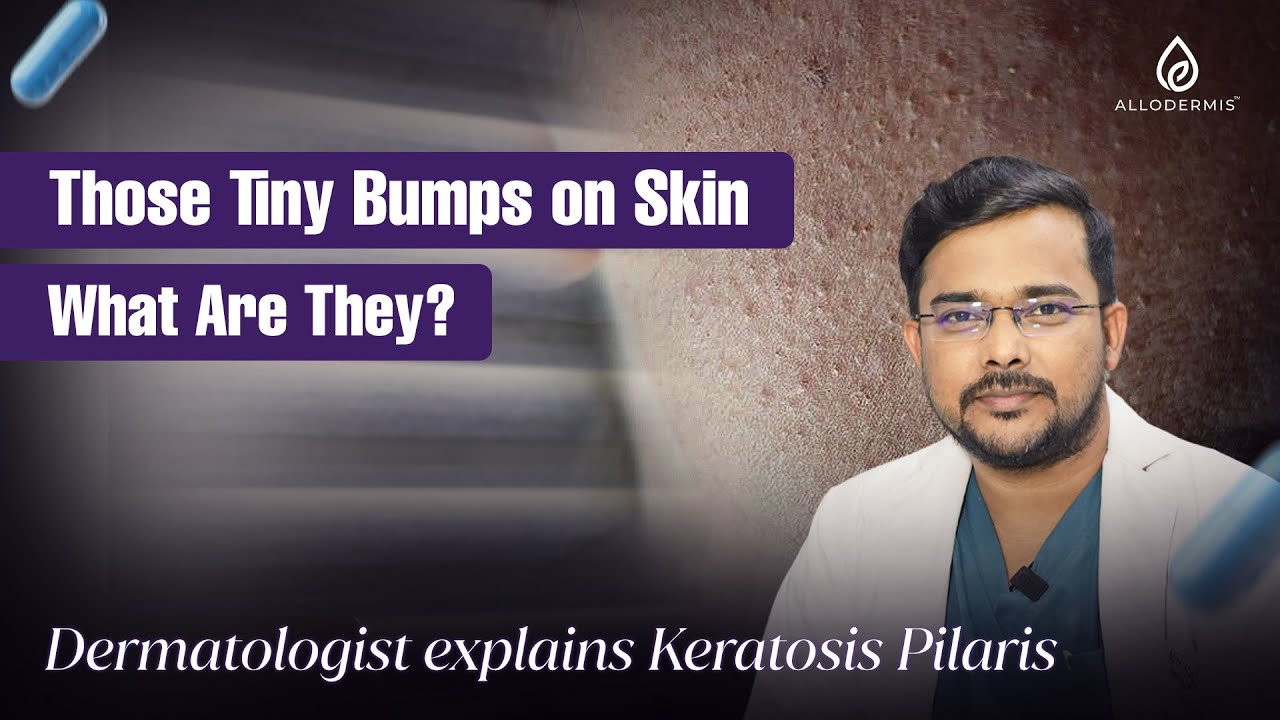 Keratosis Pilaris Explained: Why You Have Those Tiny Bumps & How to Treat Them | Dermatologist Tips