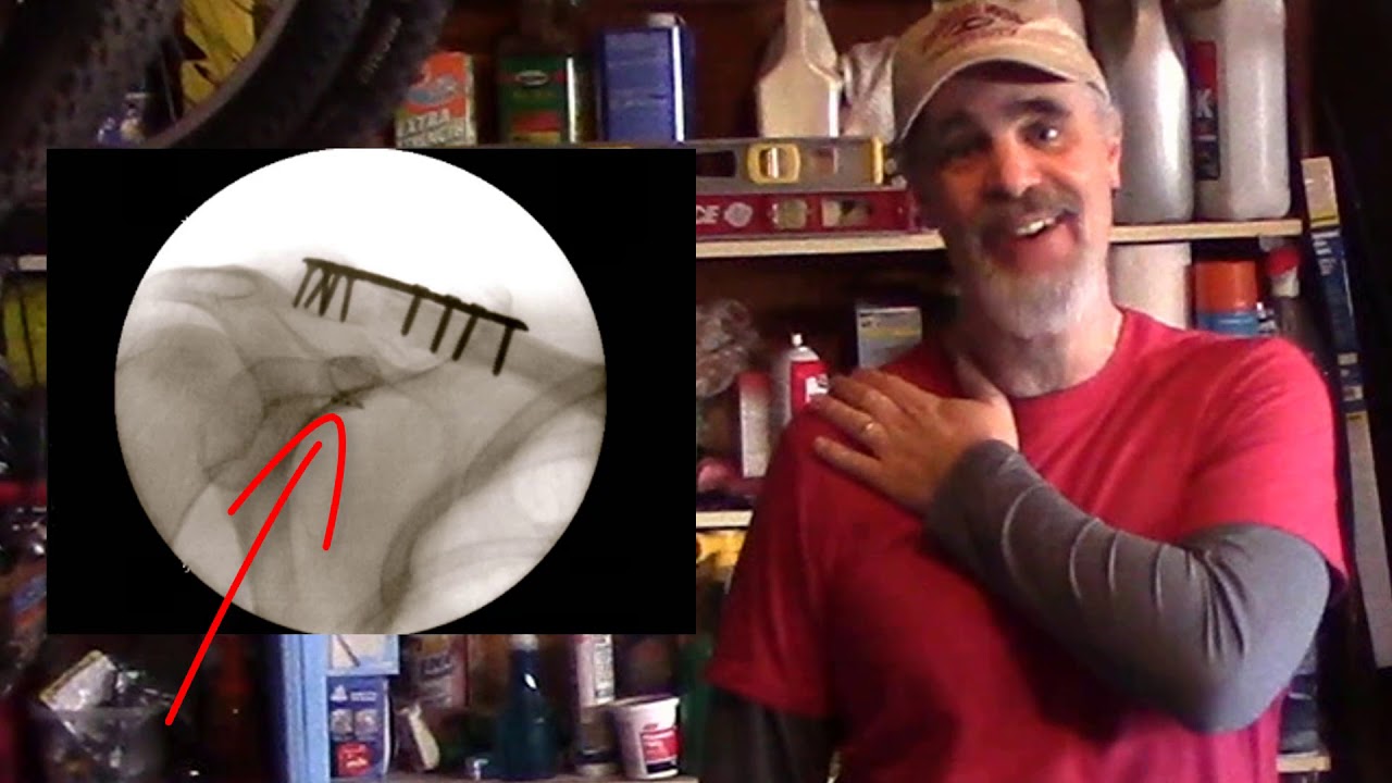 OTB Story - How I Broke My Collarbone - Plus My Rehab Exercises