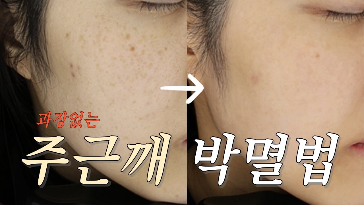 광고❌ 진짜 주근깨 없애는 법 4가지 👼 | 잡티세럼 추천 | 깐달걀 되는법 | 주근깨 박사가 알려주는 주근깨 박멸법