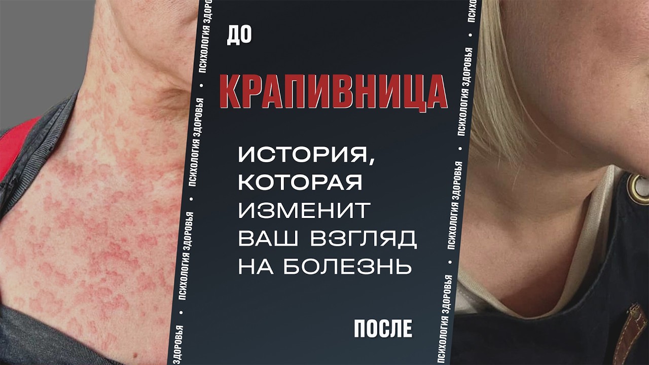Крапивница: когда кожа кричит о подавленной злости?История выздоровления.Психосоматика