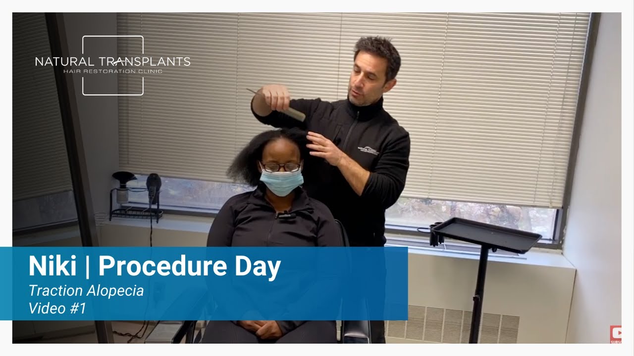 Former Military Member Treats Traction Alopecia with Hair Transplant | Dr. Blumenthal (Niki)