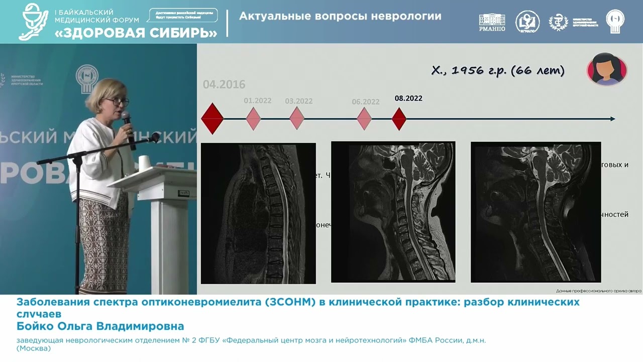 Бойко Ольга Владимировна Заболевания спектра оптиконевромиелита