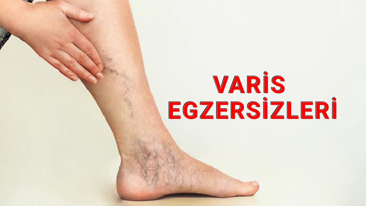 VARİS EGZERSİZLERİ