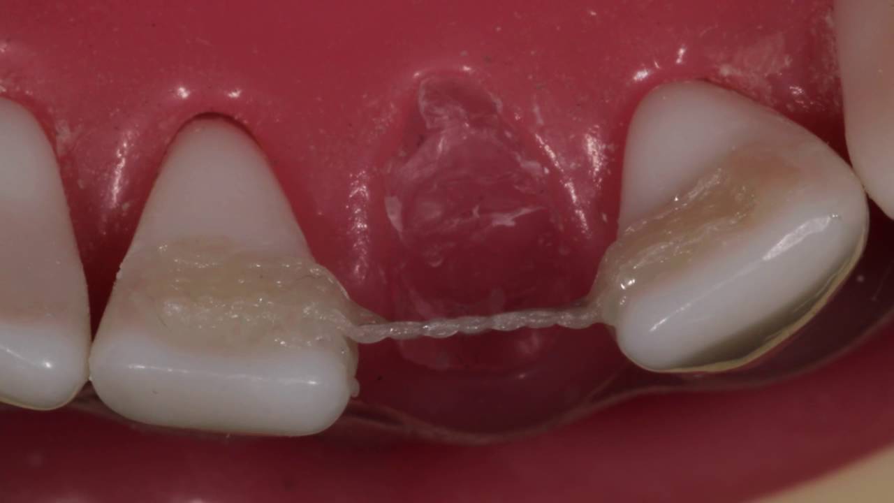 Ribbond Single Visit Bridge Technique
