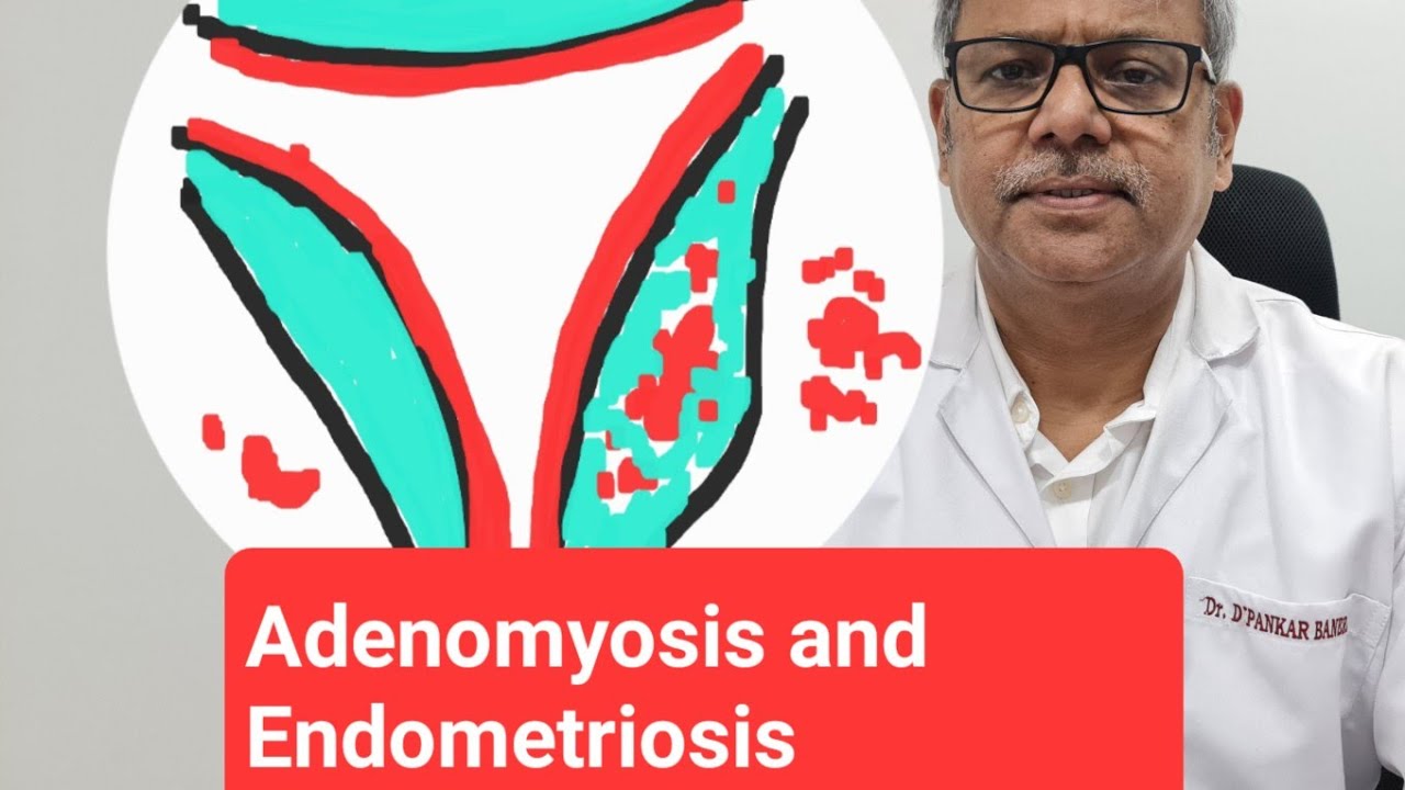 Adenomyosis and Endometriosis.. Questions Taken 18.5.2023