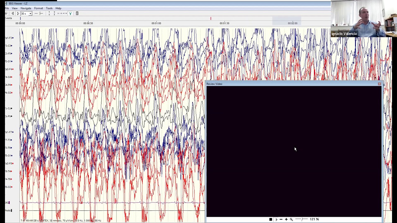 AES Professor's Rounds: Pediatric Epilepsy Case Studies