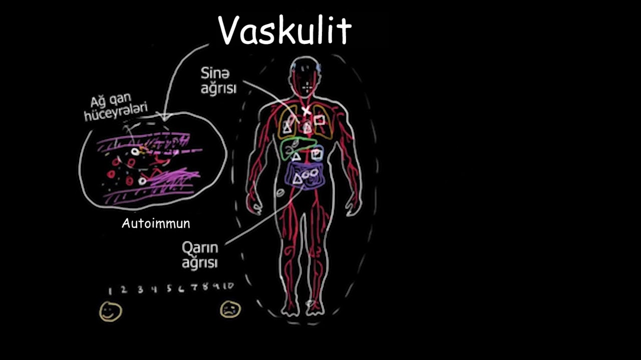 Vaskulit nədir?