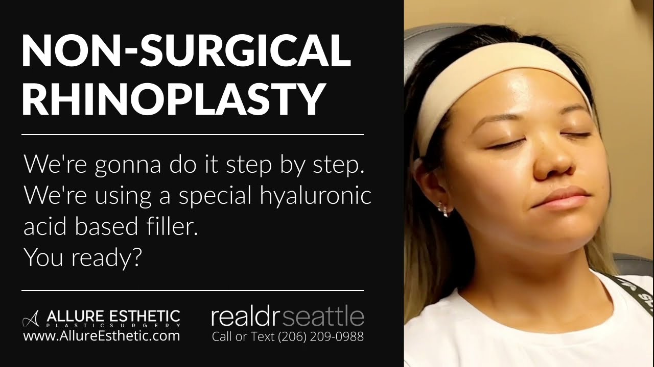 Non-Surgical Rhinoplasty! Best Technique to Build a Bridge for Asian Noses by Dr. Seattle