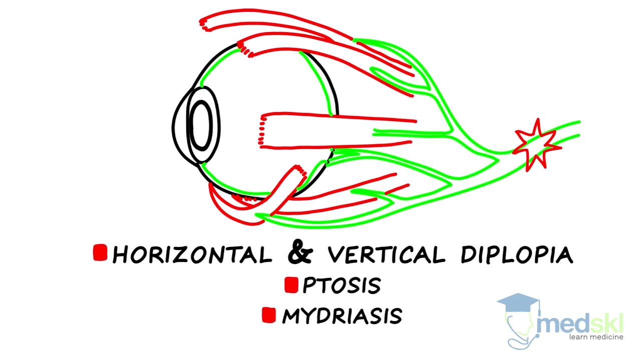 Ophthalmology – Diplopia: By Martin ten Hove M.D.