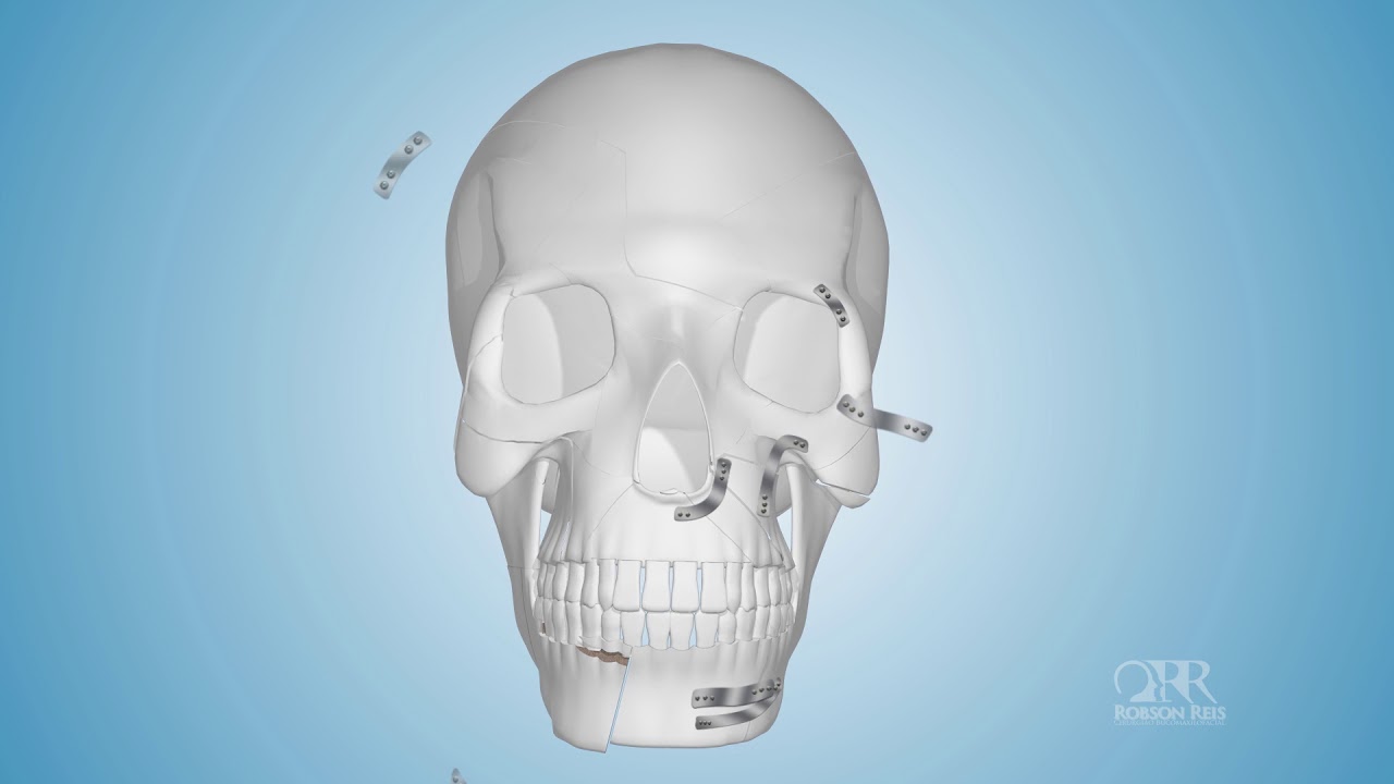 TRATAMENTO FRATURA FACIAL AVANÇADO
