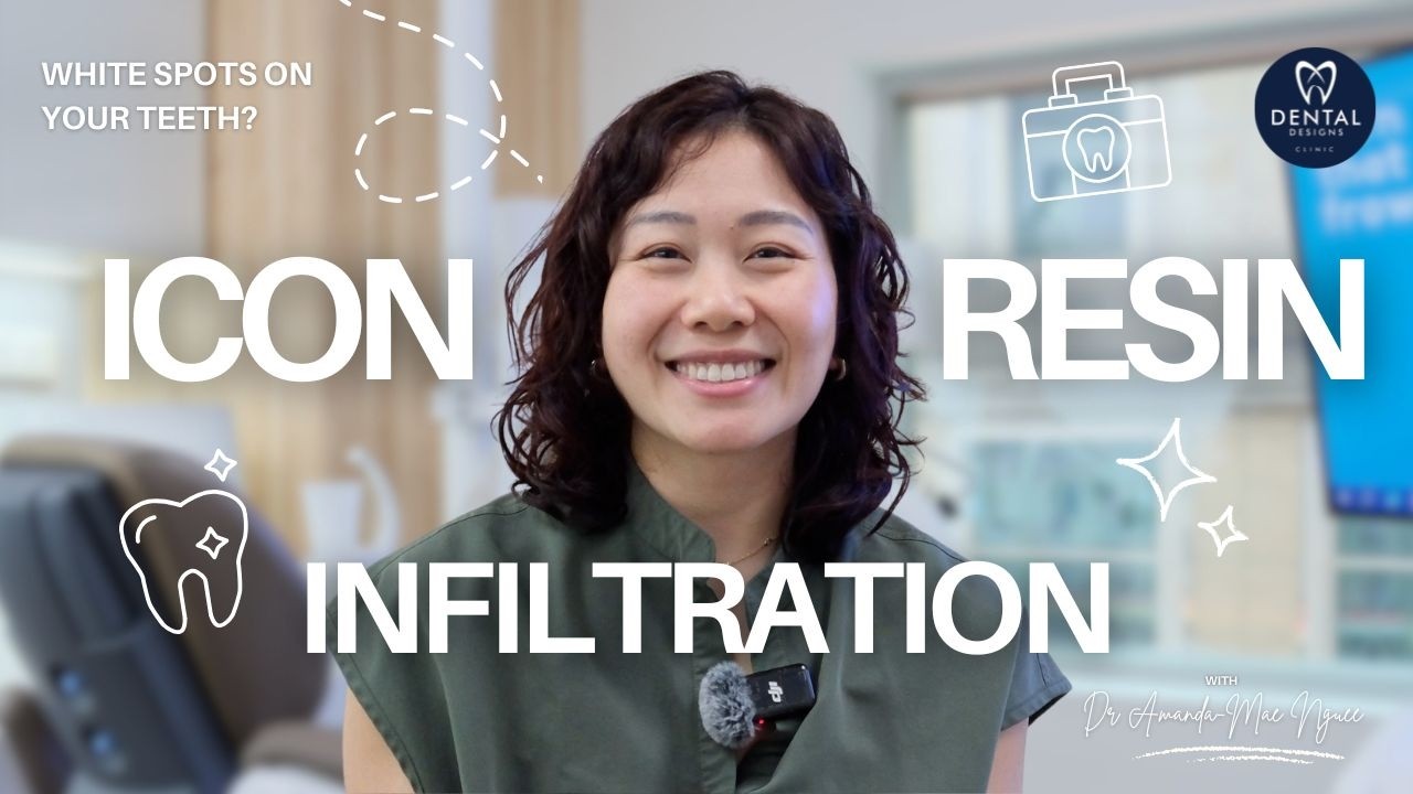 White Spots on My Teeth?! ICON Resin Infiltration Explained