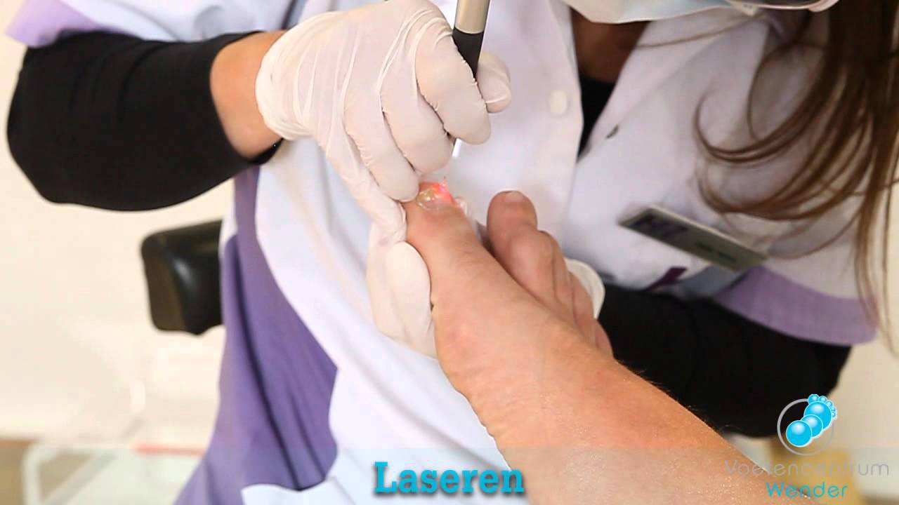 Schimmelnagelbehandeling middels Laser