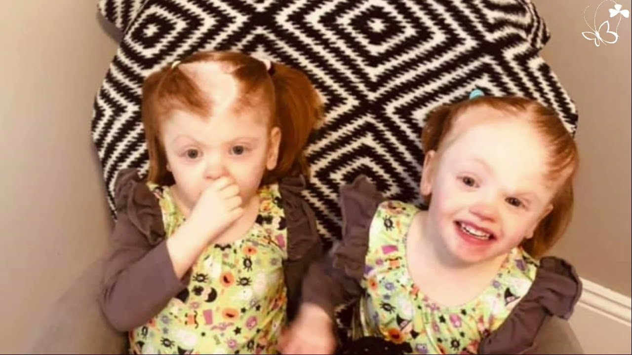 Heather Delaney shares the story of her conjoined twins & help from Kelly Anne Dolan Memorial Fund