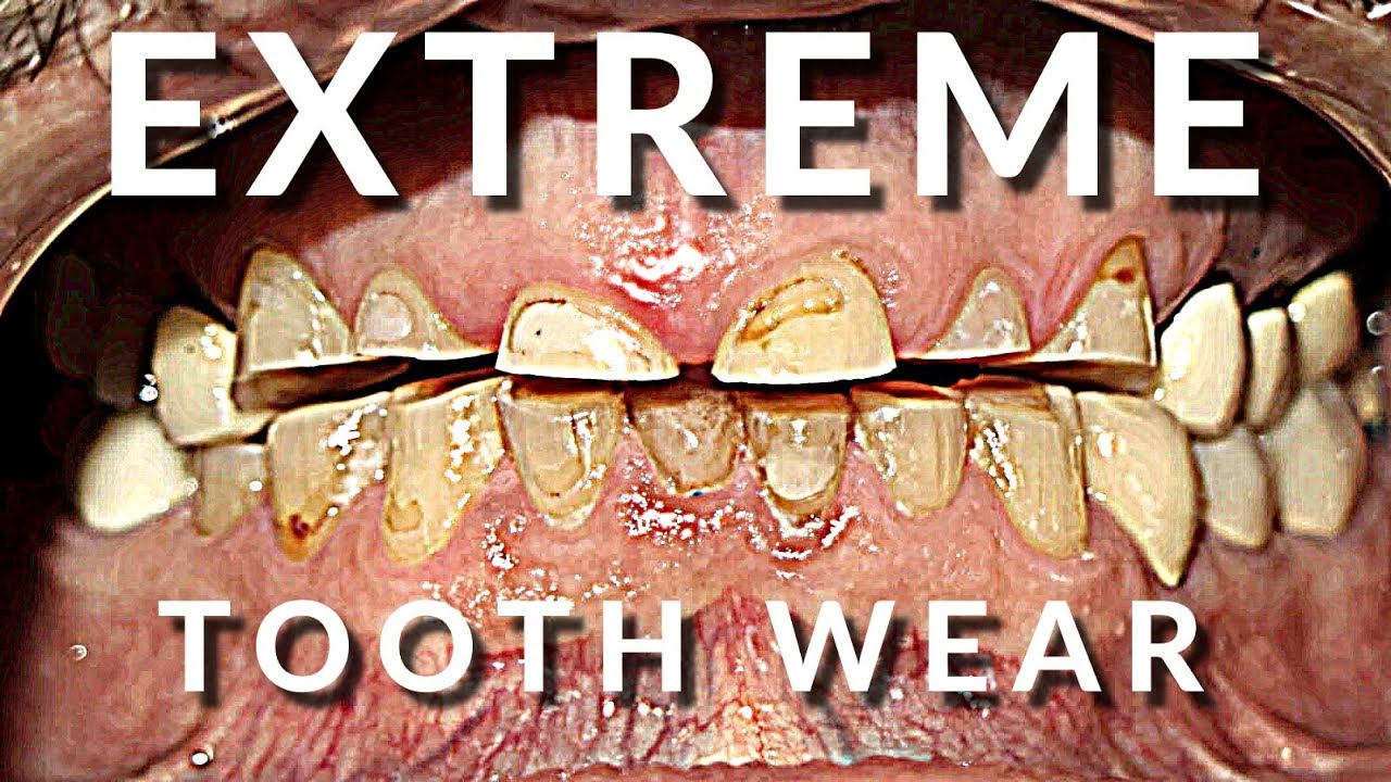 Extreme Smile Makeover 😁- Full Mouth Dental Crowns and Veneers