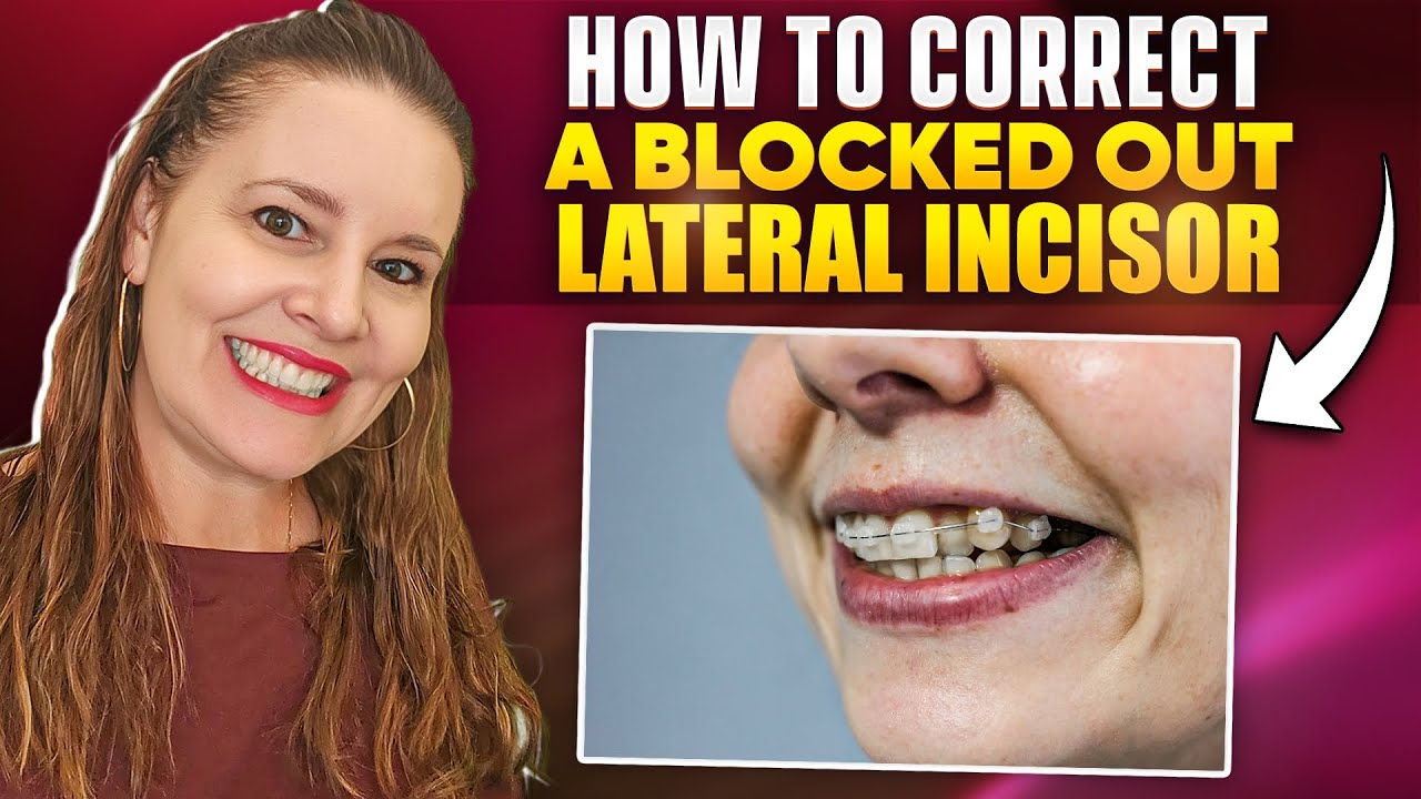 How to Correct a Blocked out Lateral Incisor