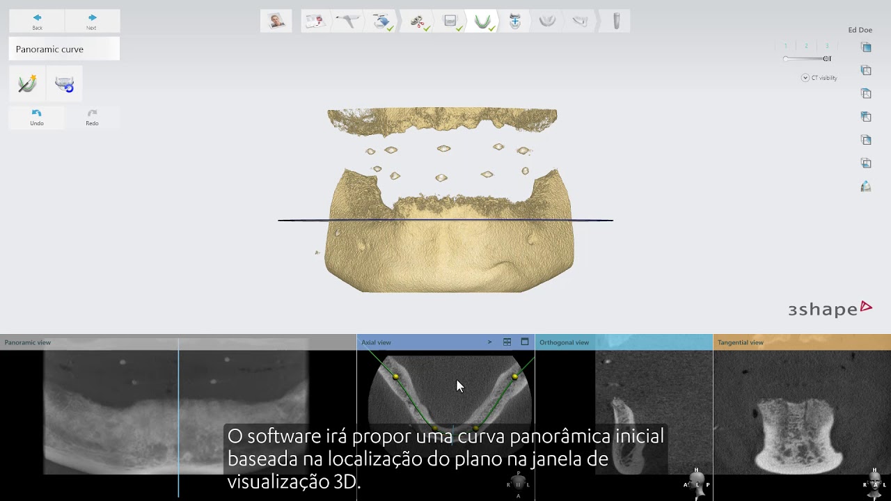 3Shape Implant Studio - Caso de Edentados - Como preparar os dados da tomografia