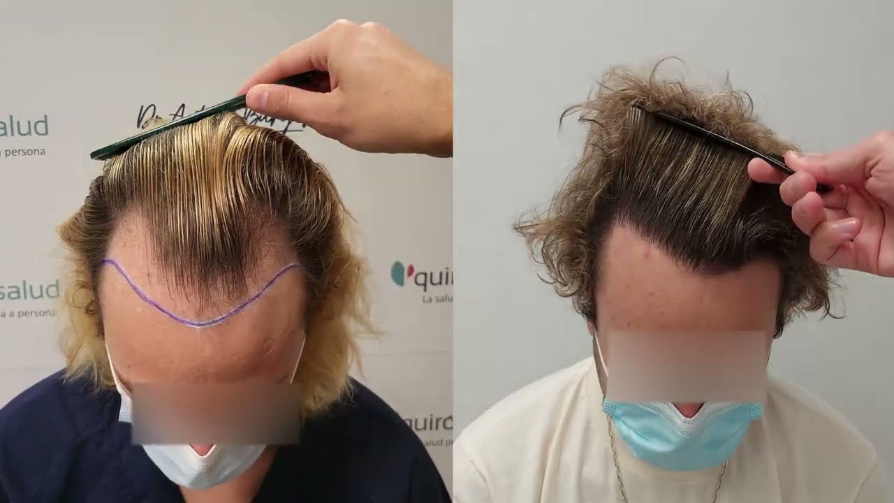 Injerto Capilar FUE - 3611 UFS - DR ANTONIO BURGOS