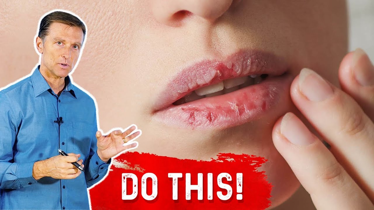 How To Fix Your Chapped Lips? &ndash; Dr.Berg On  Remedy For Chapped Lips