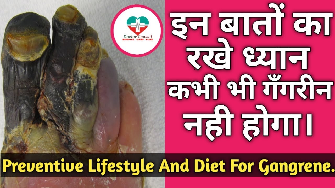 गँगरीन से बचने के आसान उपाय। Preventive Lifestyle And Diet For Gangrene.