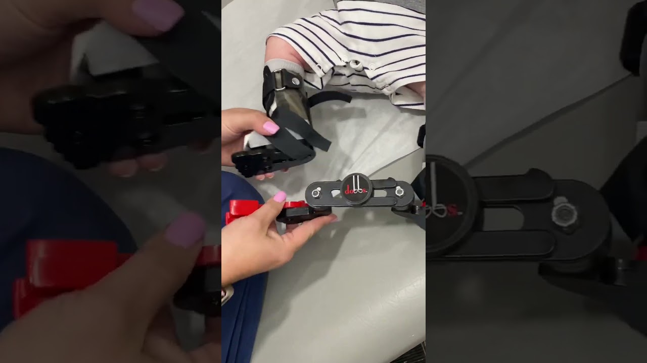 Quick release clubfoot brace  #short #shortsvideo #shortsvideo #shorts #shortsfeed #shortsyoutube ￼