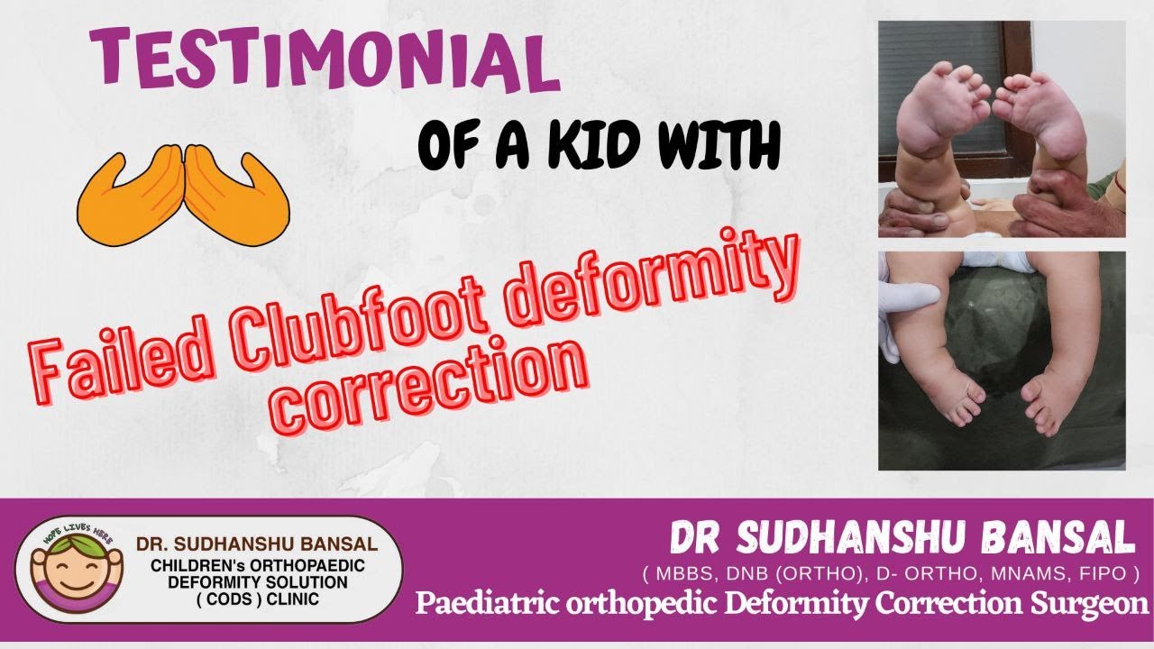 FAILED CLUBFOOT TREATMENT - PATIENT TESTIMONIAL| DR SUDHANSHU BANSAL | CODSCLINIC