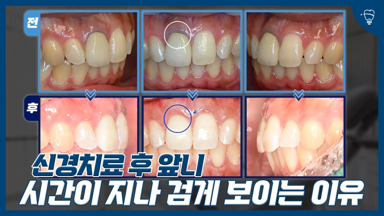 까매진 앞니 변색의 진짜 원인 | 이게 문제일 수 있습니다