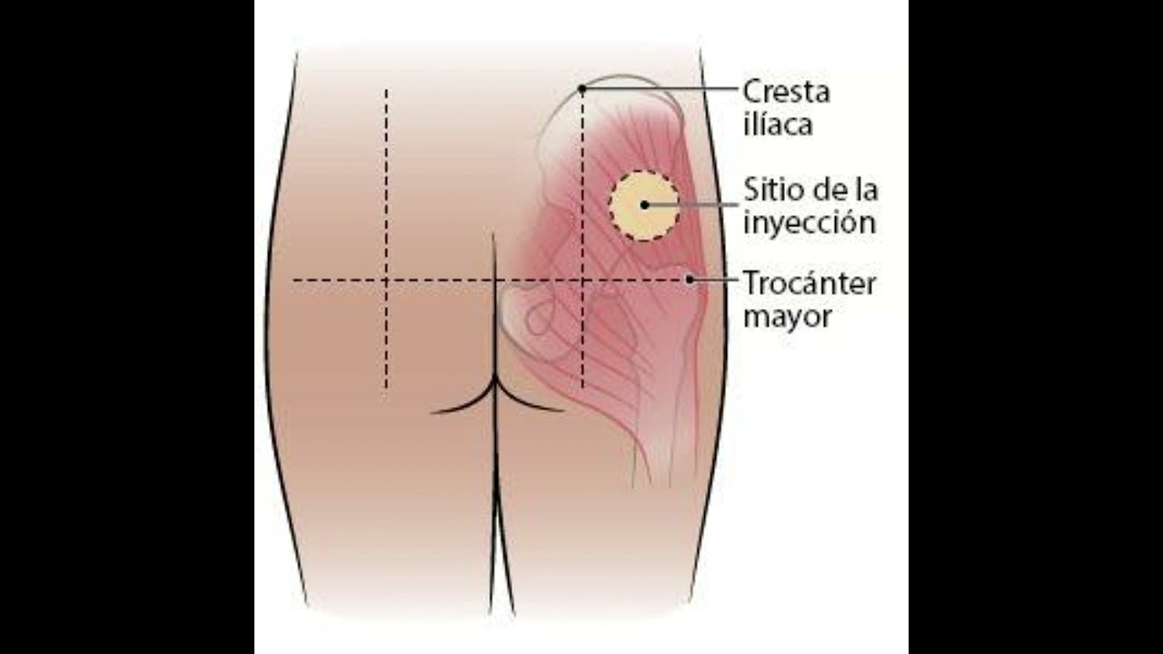 ¿Cómo aplicar inyecciones Intramusculares?