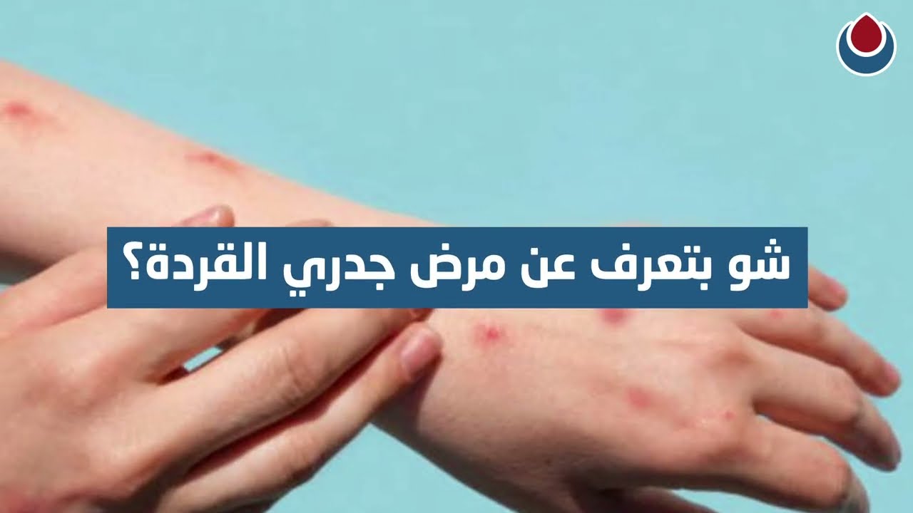 ما هو مرض جدري القردة Monkeypox