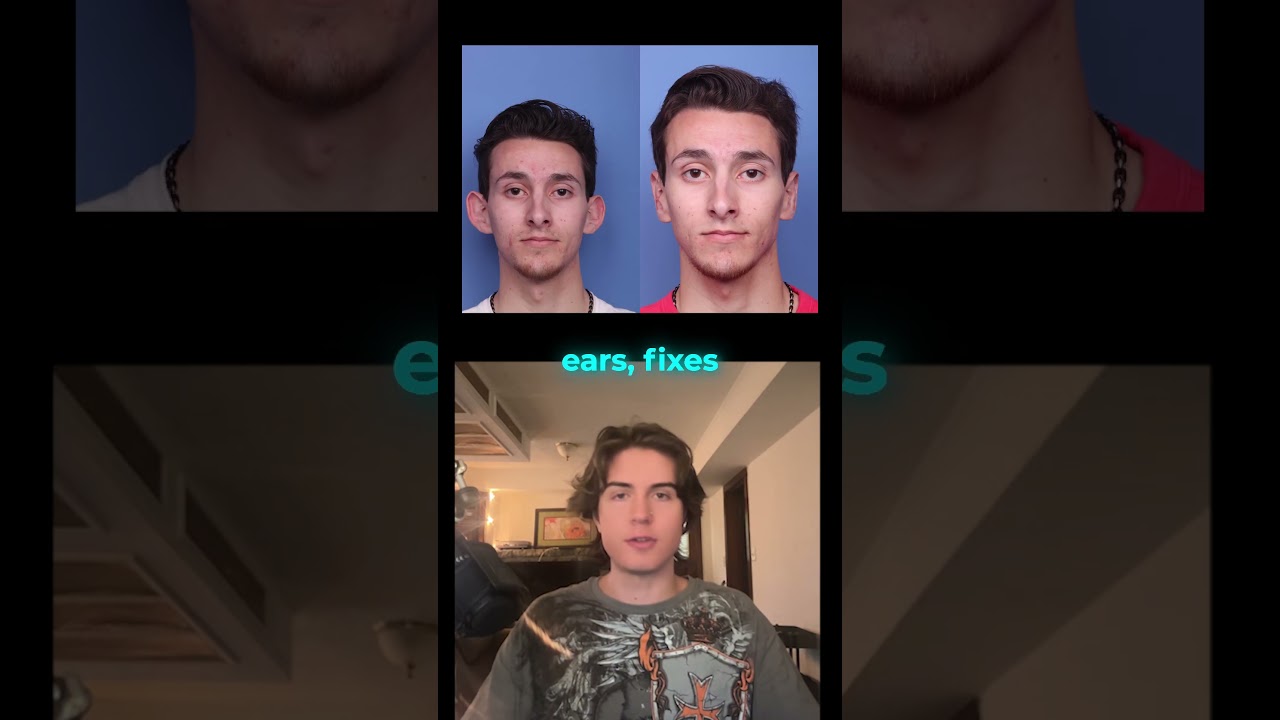 Стоит ли делать отопластику? Список уровней хирургии Looksmaxxing