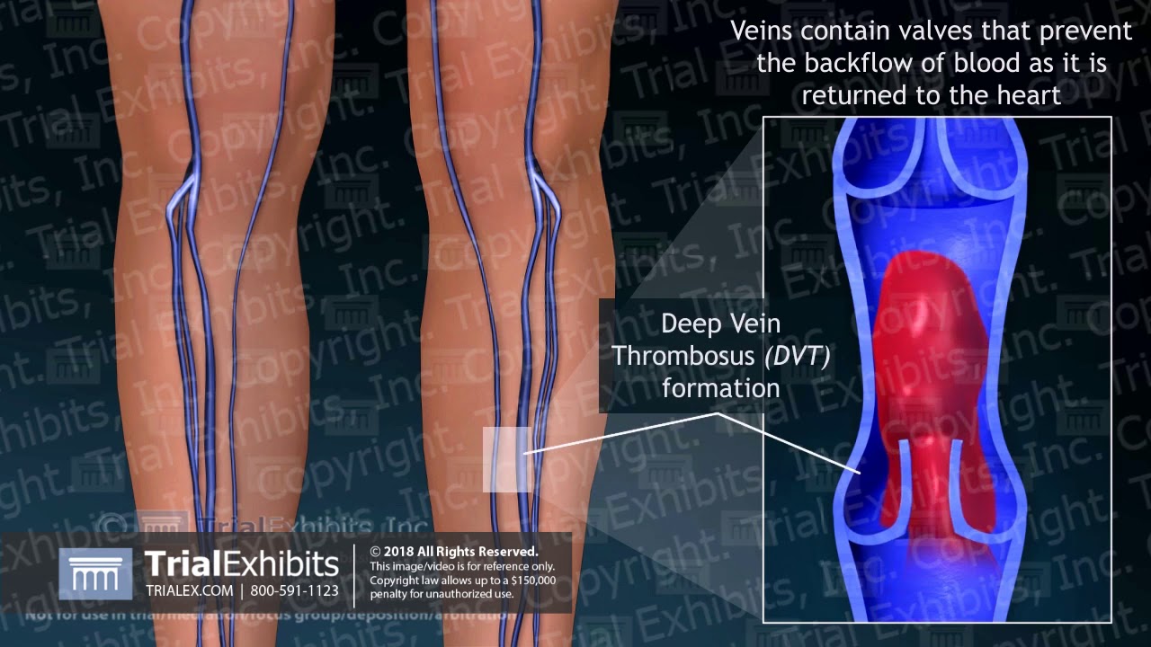 Surgical Placement of Inferior Vena Cava Filter to Prevent DVT