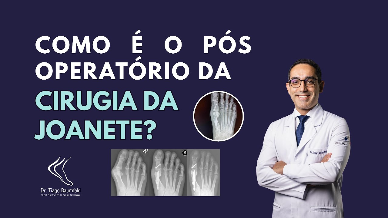 Como &eacute; o p&oacute;s operat&oacute;rio da cirurgia de joanete?