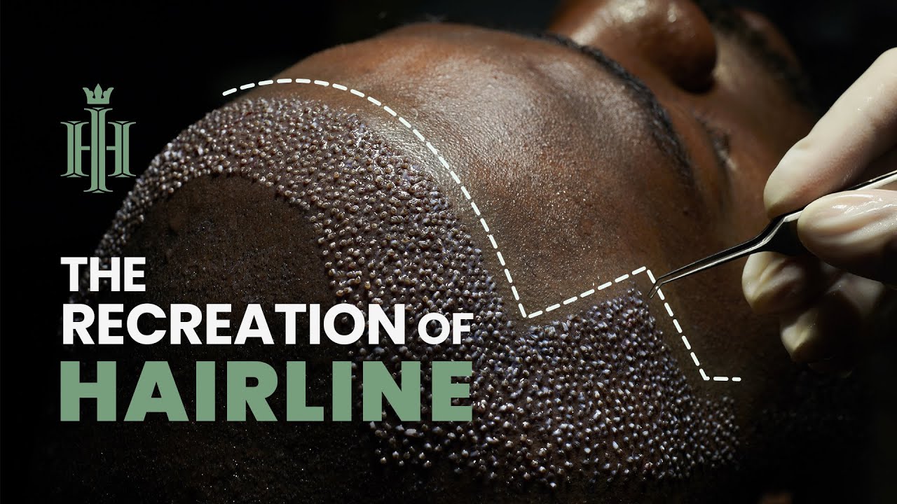 Specialized Hair Transplant for Afro-American Men | 
