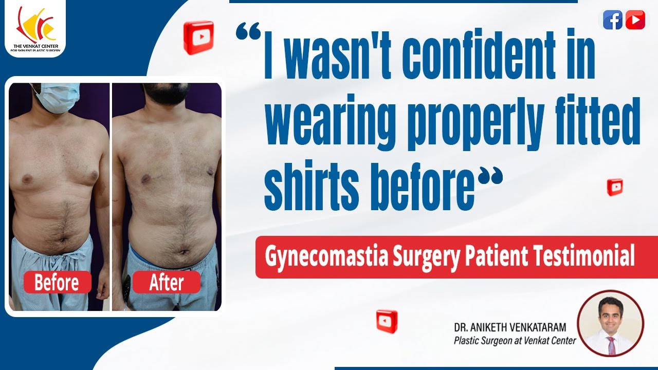 Real Gynecomastia Surgery Review: A Patient Shares His Experience | Venkat Center